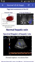 Doppler in Liver Transplant syot layar 2
