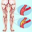 Peripheral Vascular Diseases