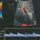 Portal hypertension APK
