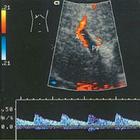 Portal hypertension ikon