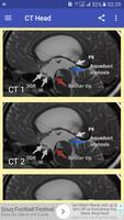 CT Head Basic Interpretation Affiche