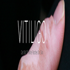 Vitiligo - Natural Cure Review biểu tượng