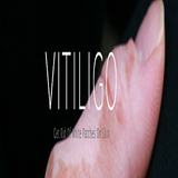 Vitiligo - Natural Cure Review icône