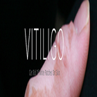 Vitiligo - Natural Cure Review-icoon