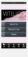 Vitiligo - Natural Cure Review Affiche