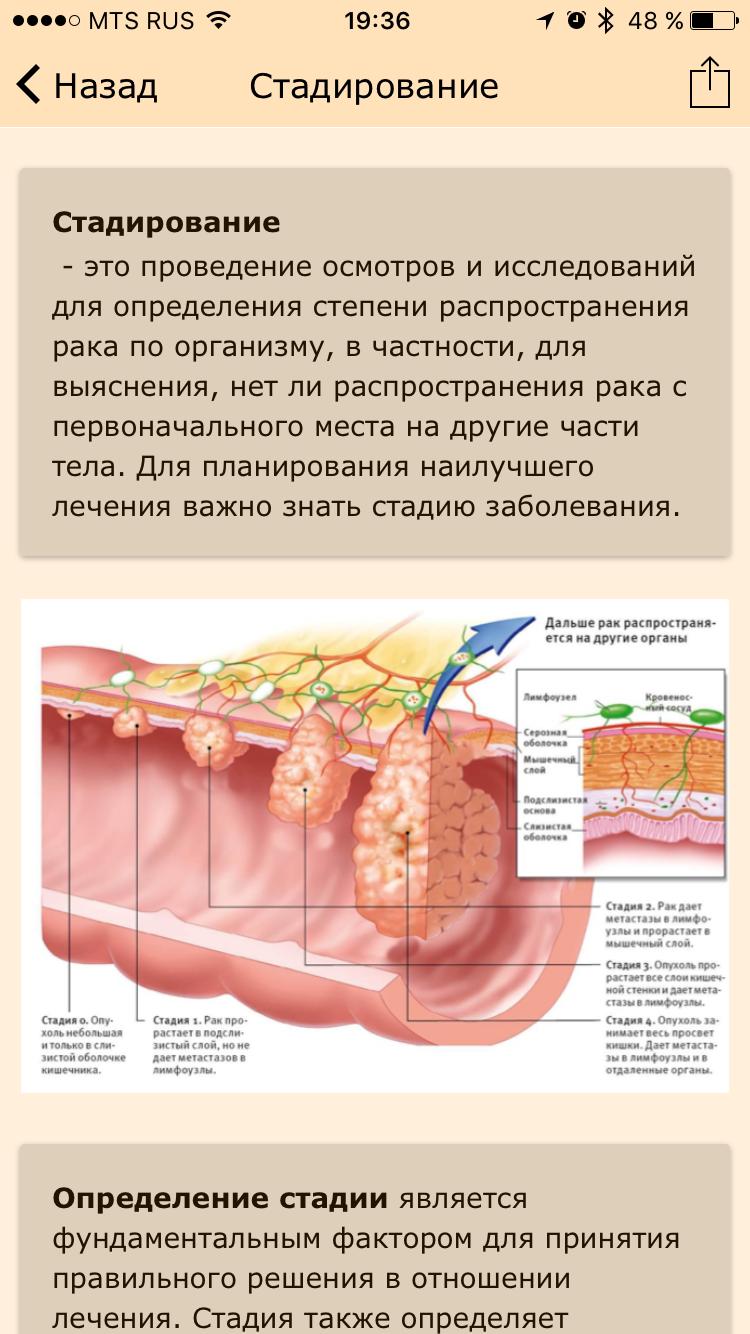 2 стадия рака кишечника