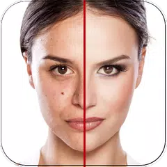 Acne Free : Pimple Remover APK download