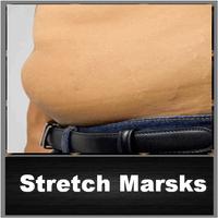 Reduce Stretch Marsks 截圖 2