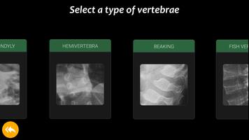 Skeletal Dysplasia View: Spine تصوير الشاشة 2