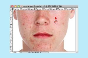 Face Blemishes Removal Cartaz