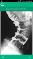 AESCULAP Spine Cervical 스크린샷 3
