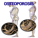 Osteoporosis Disease APK