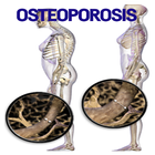 Osteoporosis Disease icône