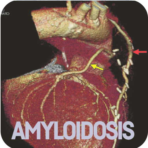 Amyloidosis Disease