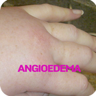 Icona Angioedema Disease