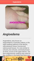 3 Schermata Angioedema Disease