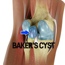 Baker's cyst Disease APK
