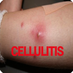 Cellulitis Infection