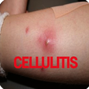 Cellulitis Infection APK