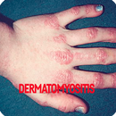 Dermatophytosis Infection APK