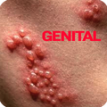 Genital Herpes