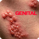 Genital Herpes icône
