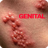 Genital Herpes 图标
