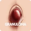 Granuloma Disease