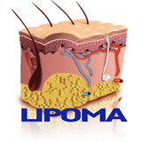 Lipoma Disease أيقونة