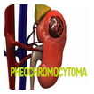 Pheochromocytoma