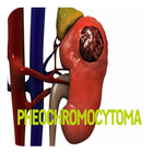 Pheochromocytoma-icoon