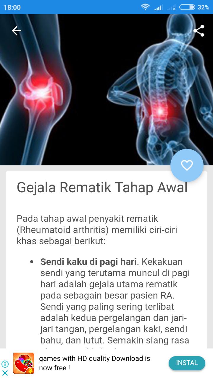 Ciri Ciri Penyakit Rematik Pada Tangan - Ini Cirinya