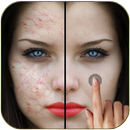 Espinilla removedor Photo Edit APK
