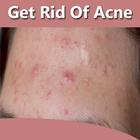 How To Get Rid of Acne Fast أيقونة