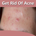 How To Get Rid of Acne Fast icône