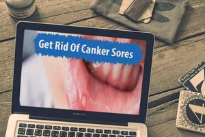 How To Get Rid Of Canker Sores 截圖 2