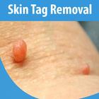 Skin Tag Removal icône