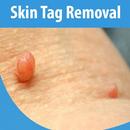 Skin Tag Removal Tips (Naturally) aplikacja