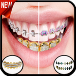 Gold Teeth & Braces photo editor