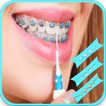braces bretelles teeth both pro
