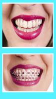 braces bretelles teeth both pro স্ক্রিনশট 2