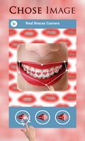 الأقواس اسنان - Braces تصوير الشاشة 1