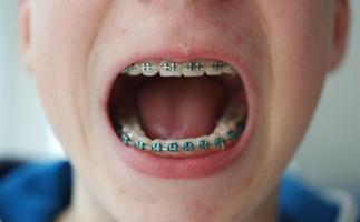 پوستر braces colored teeth real