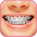 Braces Bretelles teeth both 2018