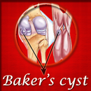 Bakers Cyst APK