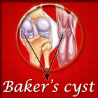 Icona Bakers Cyst