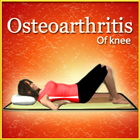 Osteoarthritis of knee Zeichen