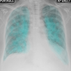 Chest X-Ray And Pathology APK