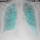 Chest X-Ray And Pathology-icoon