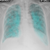Chest X-Ray And Pathology icône